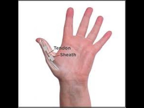 /NEURO - CARPAL TUNNEL DECOMPRESSION OR RELEASE ONE SIDE